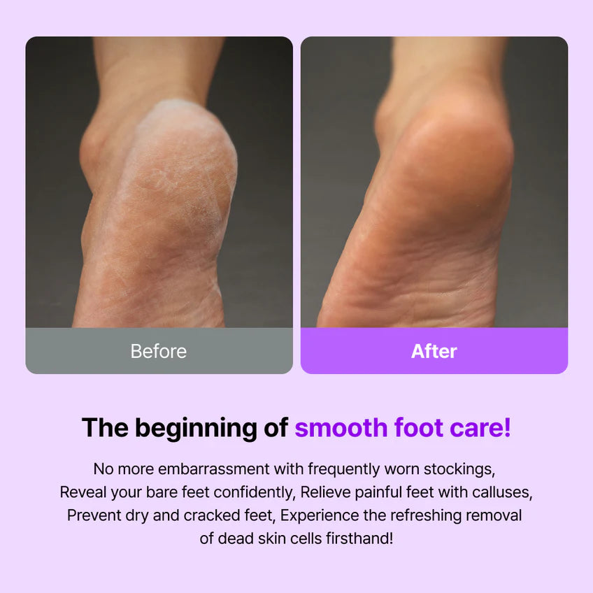 BAREN Callus Remover The Whale Foot File